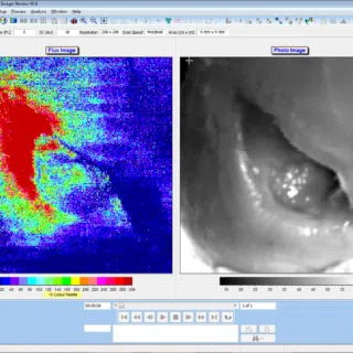 Images reproduced with kind permission of Dr Faisel Khan and Dr David Newton, Ninewells Hospital, Dundee. Pre-treatment.