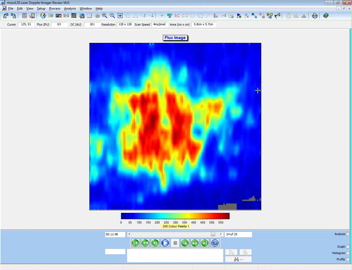 Wheal and flare microvascular response to microdialysis of histamine in the forearm. Image reproduced with kind permission of Professors Church and Clough, Southampton. Wheal and flare microvascular response to microdialysis of histamine in the forearm. Image reproduced with kind permission of Professors Church and Clough, Southampton.