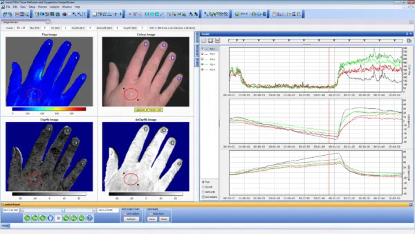 Post Occlusive Reactive Hyperaemia protocol (PORH) – illustrated during the ischemic phase of the recording.